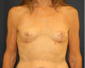 Feel Beautiful - Breast Implant Removal 202 - After Photo